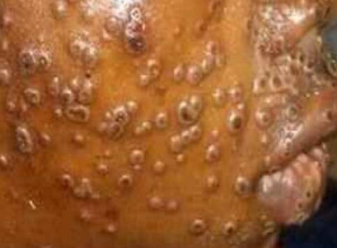 엠폭스 여전한데 두창백신 정부 예산 72.7% 삭감