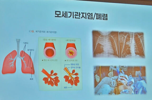아이가 숨을 ‘색색’ 쉰다면…RSV, 소아 폐렴 등 합병증 중요 원인