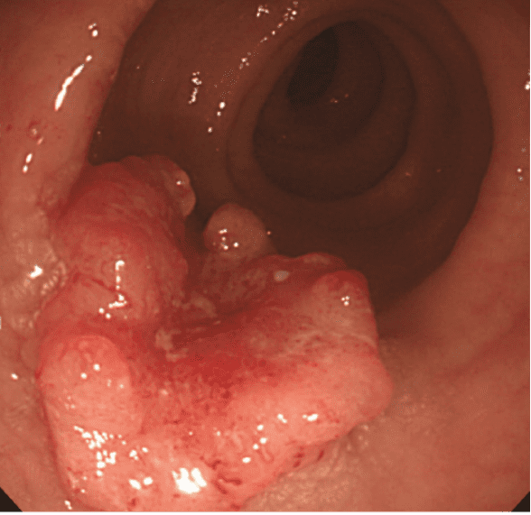 [1분건강] 대장내시경검사 받은 사람이 대장암 발생‧사망률 더 낮다