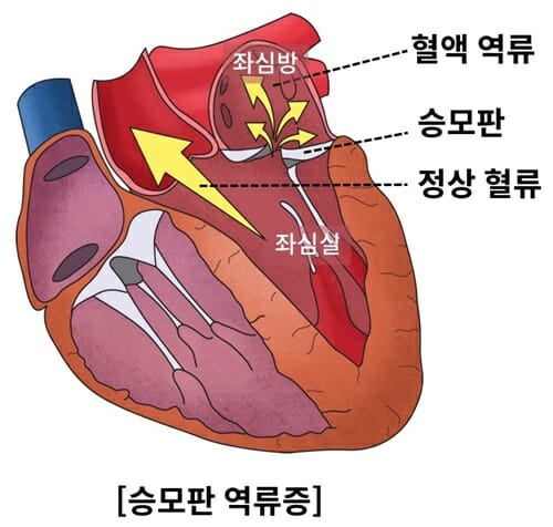 중증 승모판 역류증, 성별 따라 수술 시점 달라져야