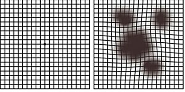 [1분건강] 초고령화 속 황반변성 증가…자칫 실명 위험도