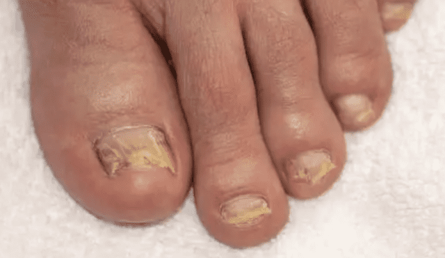 [1분건강] 장마철 찾아오는 무좀‧식중독…올여름은 피하자