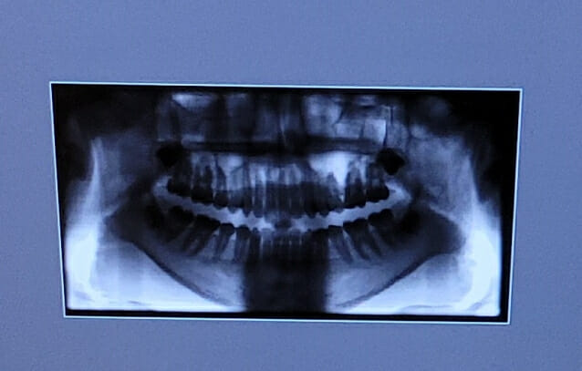 골다공증 치료제 투여 환자, 발치 후 턱뼈 괴사 위험