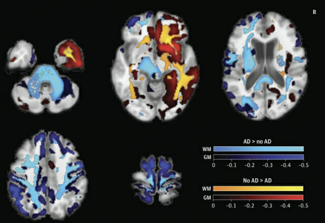 ‘알츠하이머병’ 완벽 감별하는 족집게 물질 찾았다
