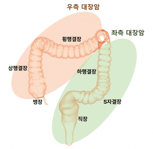 [1분건강] 여성 대장암 절반 이상 ‘오른쪽’에서 발생한다