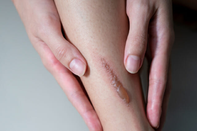 [1분건강] 화상 비대성 흉터, ‘메티오닌’ 제한으로 치료 기대