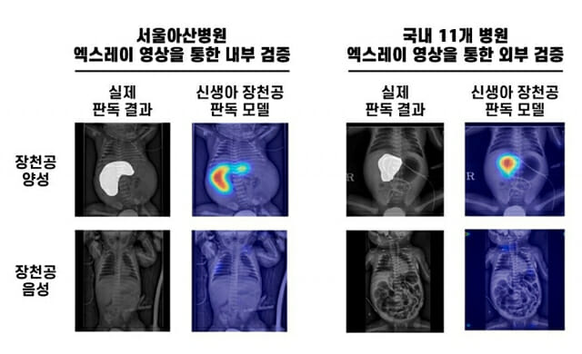 신생아 생명 위협하는 ‘장천공’ AI로 조기 진단 가능