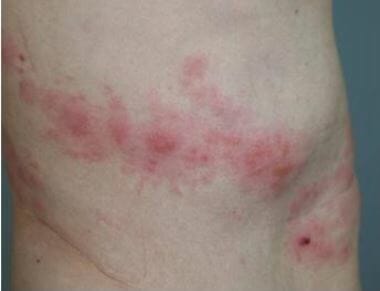 어르신 대상포진 진료비 느는데 예방접종 비용은 천차만별