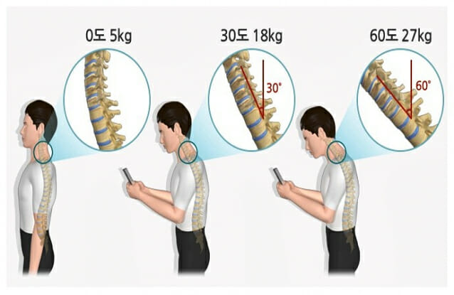 [1분건강] 스마트폰 보느라 고개 숙인 당신…거북목증후군 부른다